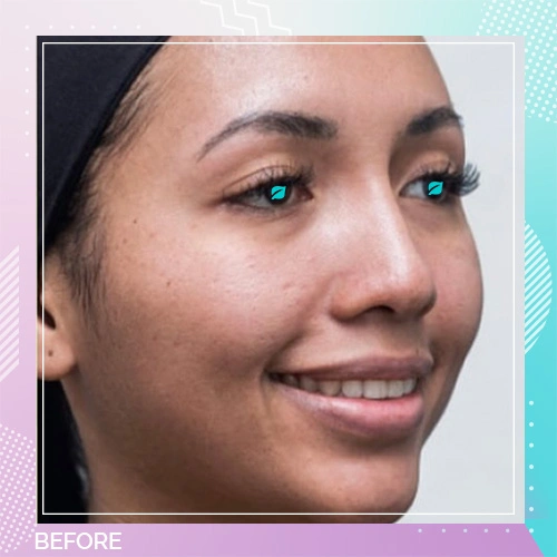 Skin Booster patient before 1
