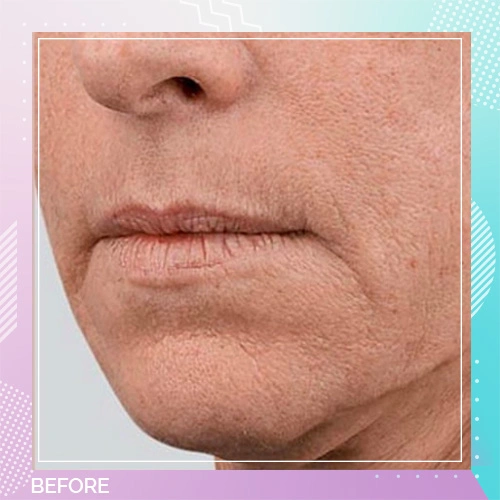 Skin Booster patient before 4