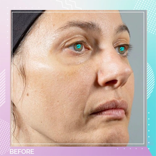 Skin booster Patient Before 2