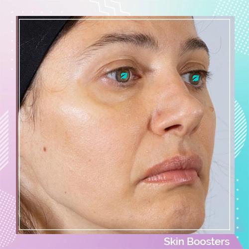 Skin booster patient after 2