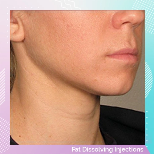 fat dissolving injections patient 1 after
