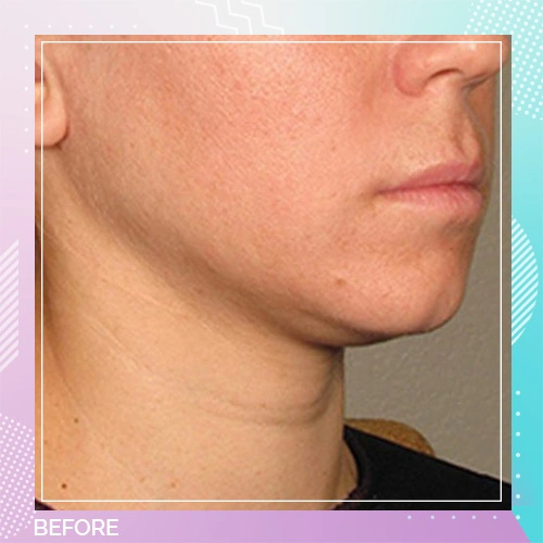 fat dissolving injections patient 1 before