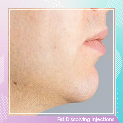 fat dissolving injections patient 2 after
