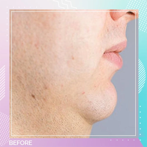 fat dissolving injections patient 2 before
