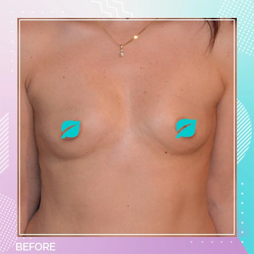 Breast implant patient 5 before