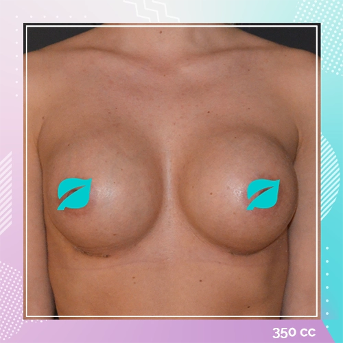 Breast implant patient 7 after