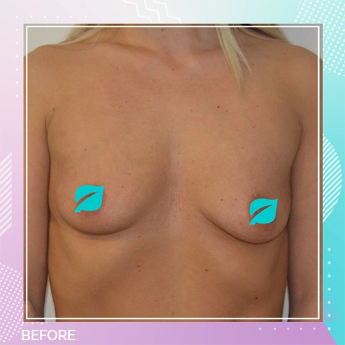 Breast implant patient 7 before