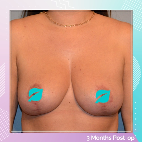 Breast reduction patient 6 after