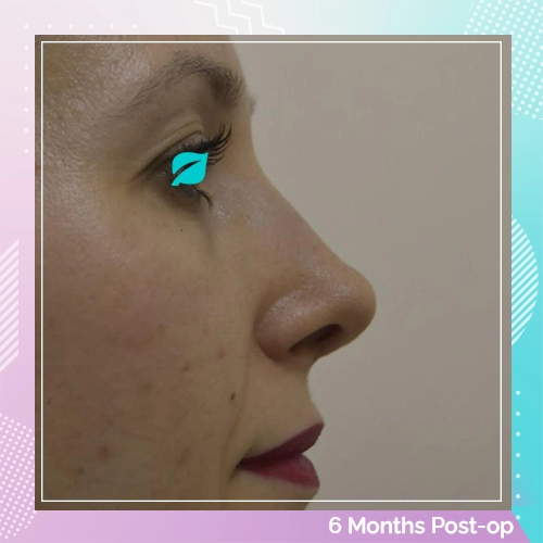 Nose Job Patient 15 after