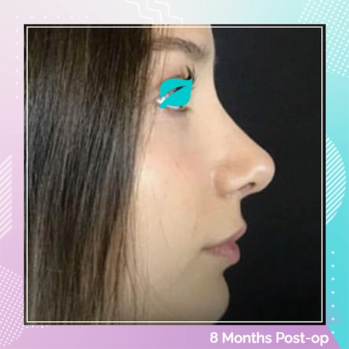 Nose Job patient 2 After