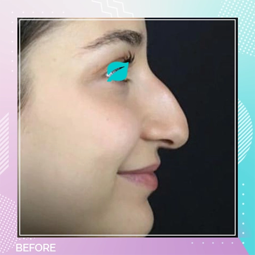 Nose Job patient 2 Before