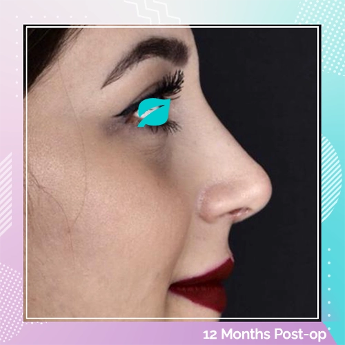 Nose Job patient 4 After
