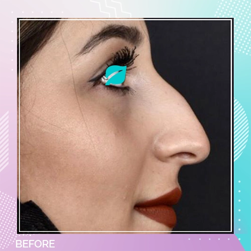 Nose Job patient 4 Before