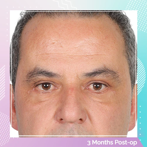 eyelid patient 5 after