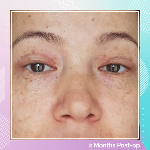 eyelid patient 6 after