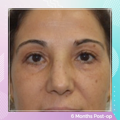 eyelid patient 7 after