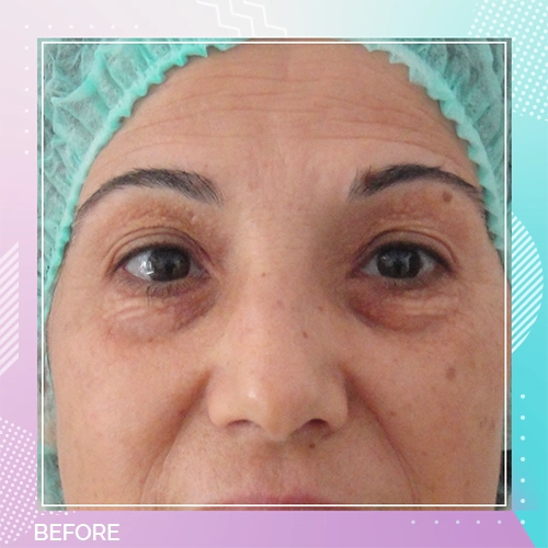 eyelid patient 7 before