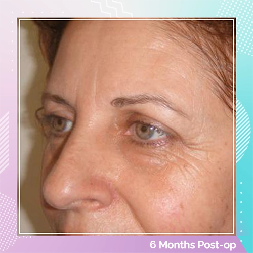 eyelid patient 8 after