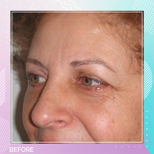 eyelid patient 8 before