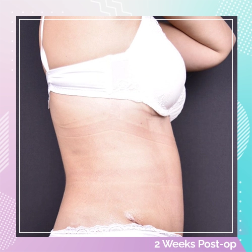 tummy tuck patient 1 after
