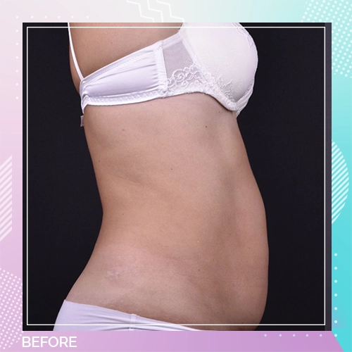 tummy tuck patient 1 before