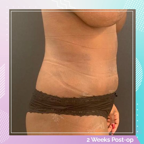 tummy patient 1 after