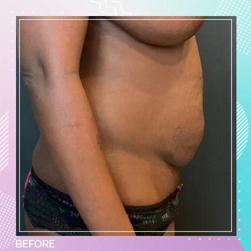 tummy patient 1 before