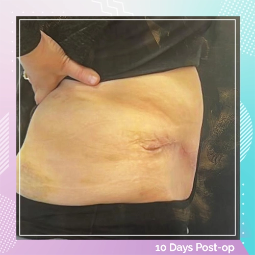 tummy patient 2 after