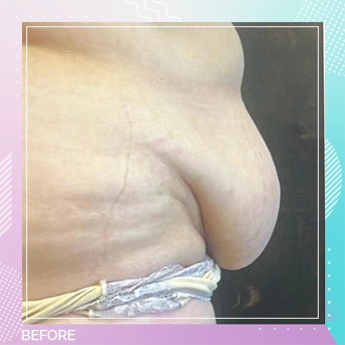 tummy patient 2 before