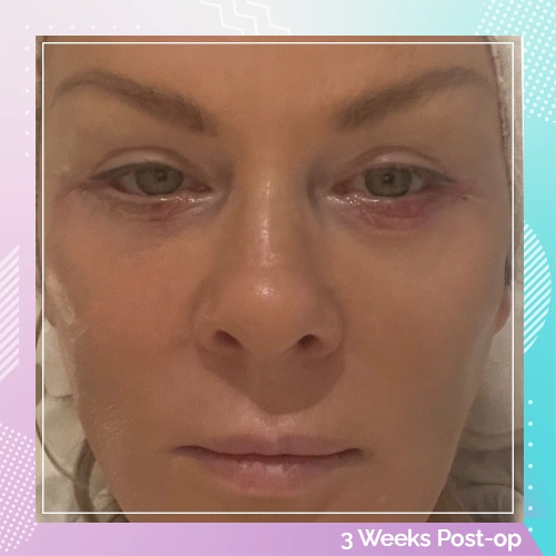 HS Double Eyelid Full Facelift After