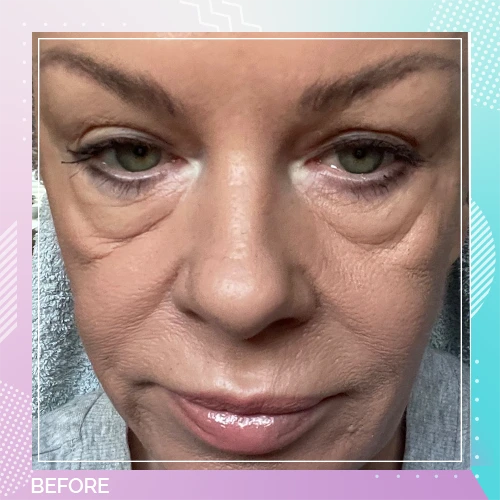 HS Double Eyelid Full Facelift Before