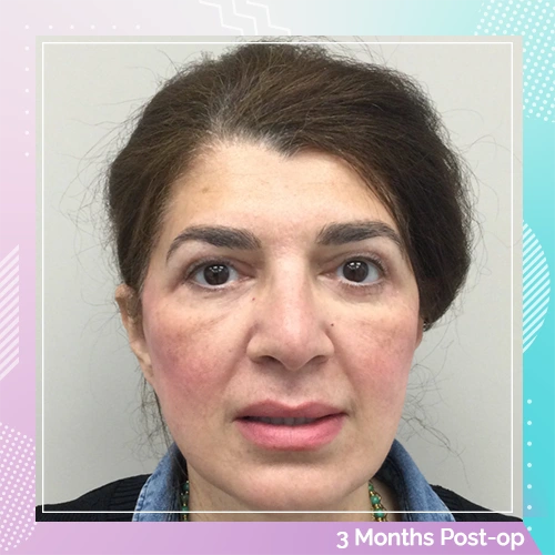 HS Double Eyelid Full Facelift Patient 2 After 2