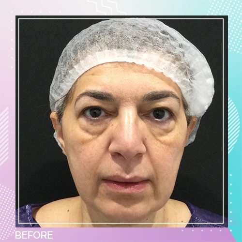 HS Double Eyelid Full Facelift Patient 2 Before
