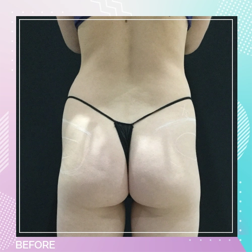 HS Liposuction BBL Patient 5 Before