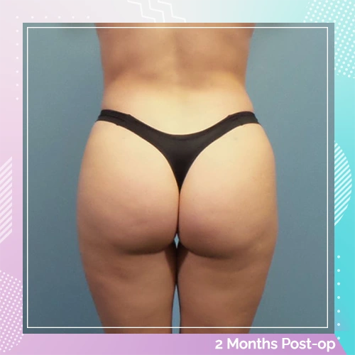 HS Liposuction BBL Patient 6 After