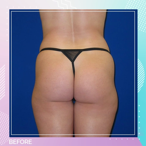 HS Liposuction BBL Patient 6 Before