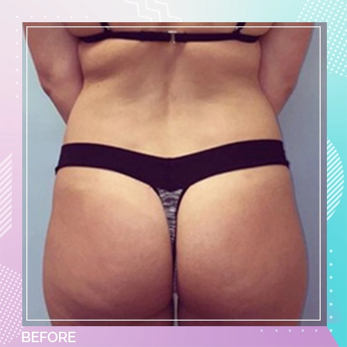 HS Liposuction BBL Patient 7 Before