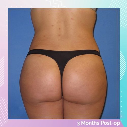 HS Liposuction BBL Patient 8 After
