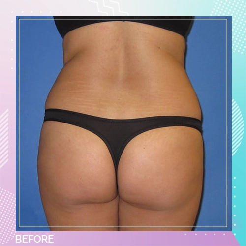 HS Liposuction BBL Patient 8 Before