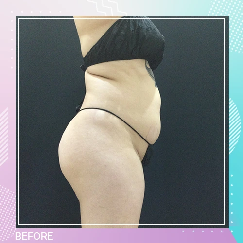 HS Liposuction Patient Before