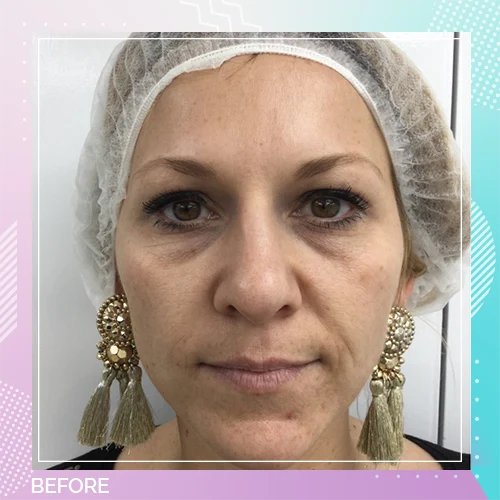 HS Lower Eyelid Mid Facelift Patient Before