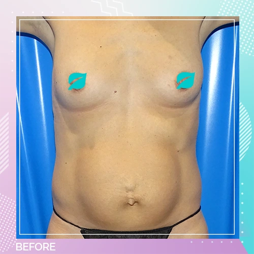 HS Mummy Before