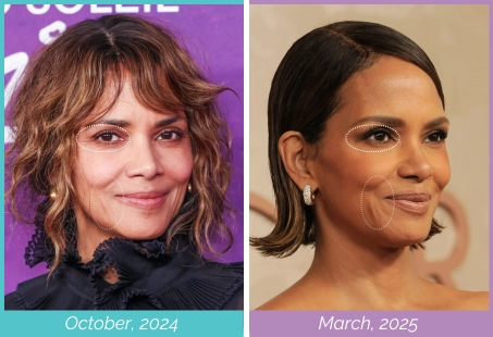 Hale Berry cosmetic procedures