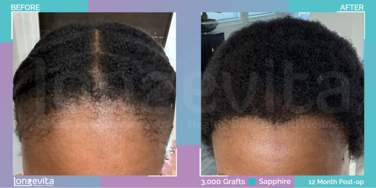 afro hair transplant turkey sapphire fue