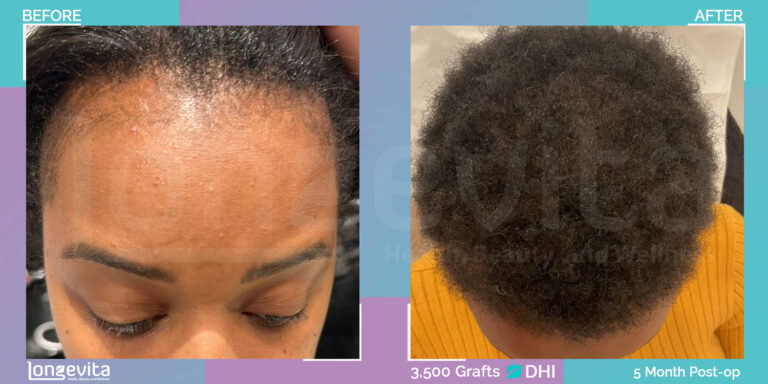 afro woman hair transplant turkey before after