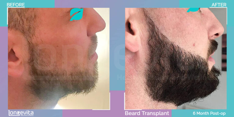 beard transplant turkey before after