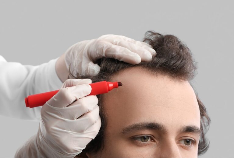 dhi hair transplant turkey