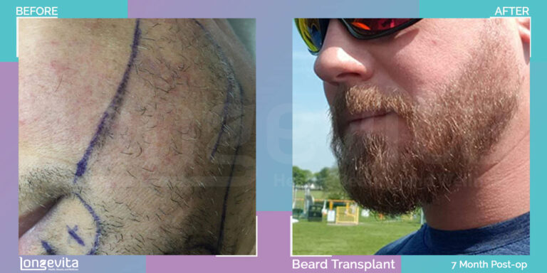 fue beard hair transplant turkey before after results