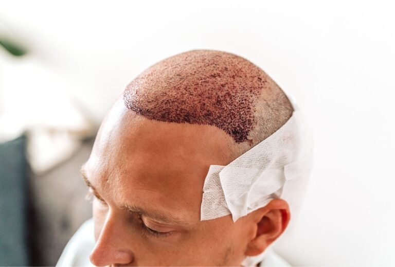 hair transplant turkey for men