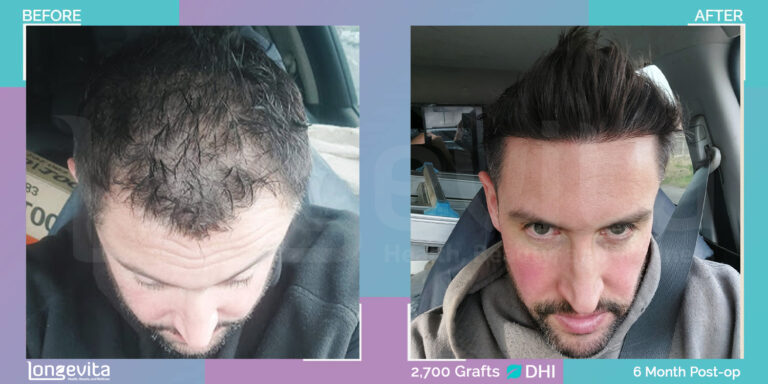 male dhi hair transplant turkey before after